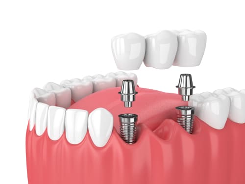 What Is A Dental Bridge Amherst Dentist Williamsville Dentist