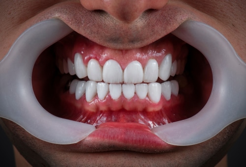 5 Ways to Transform Your Smile with Dental Veneers - Niles Family Dentistry  in Niwot